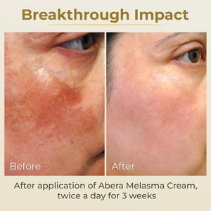 ABERA Melasma Cream - ABERA SHOP