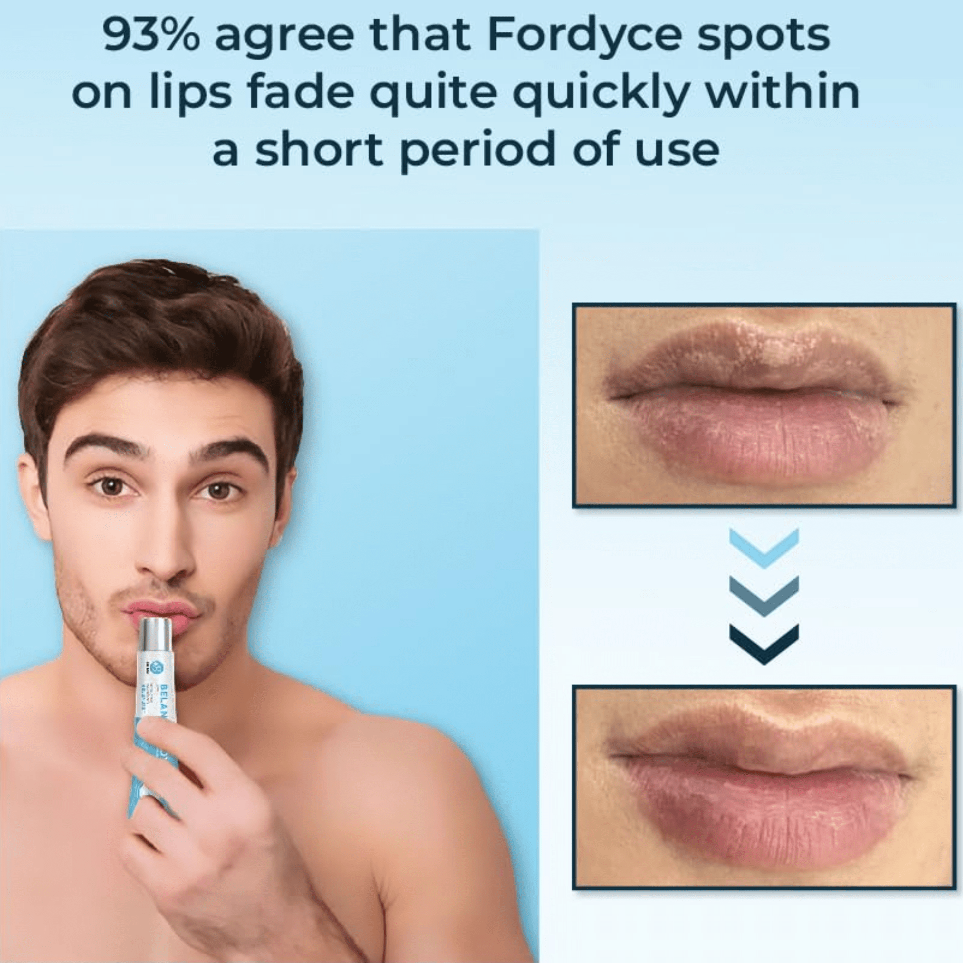 Belani Fordyce Spots Lip Cream, Hydrating Dark Lip Treatment, Fordyce Seeds 0.7 fl oz