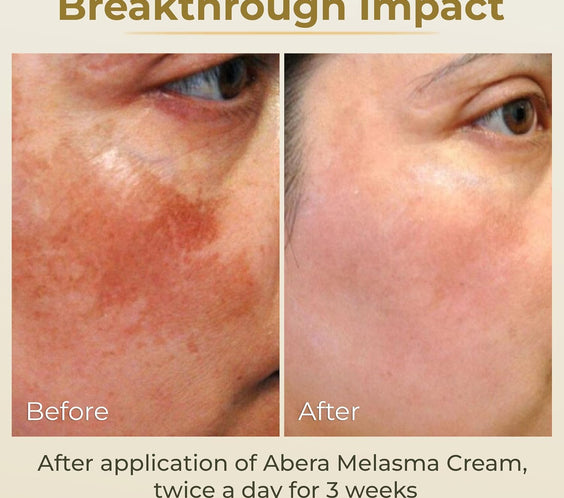 ABERA Melasma Cream