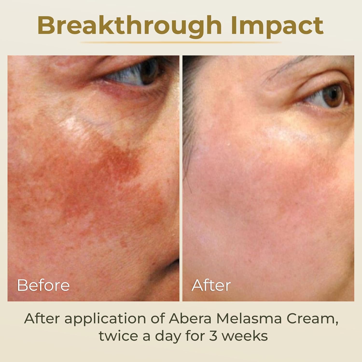 ABERA Melasma Cream