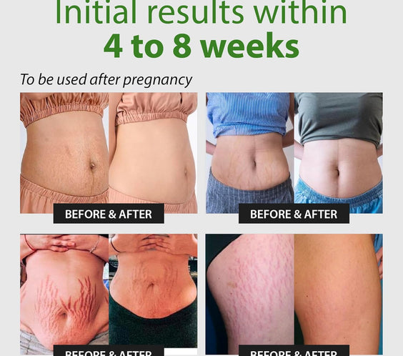 Abera Ovela Stretch Mark Cream