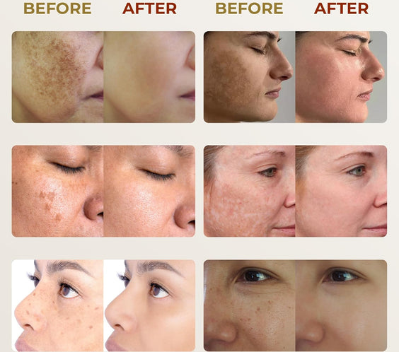 ABERA Melasma Cream