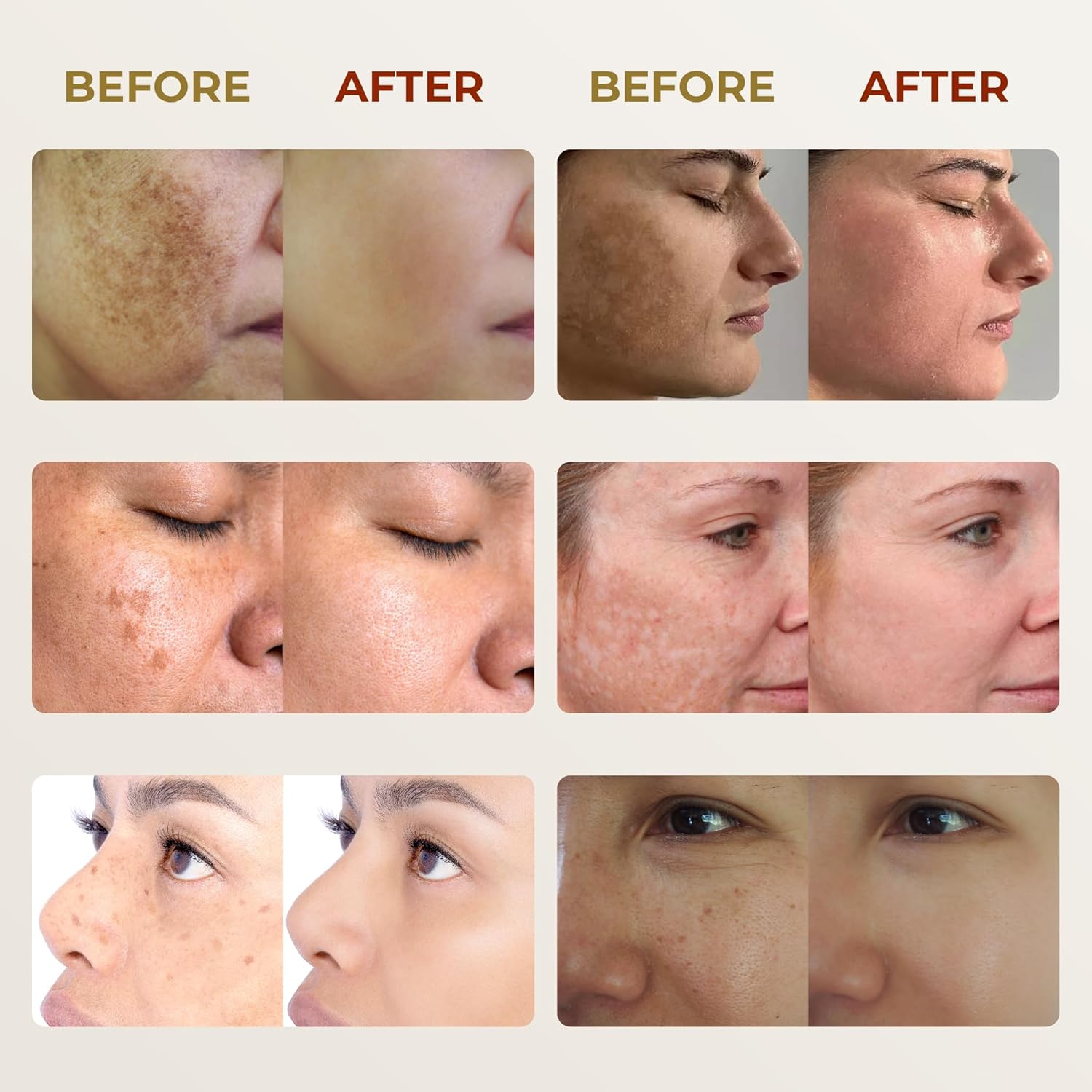ABERA Melasma Cream