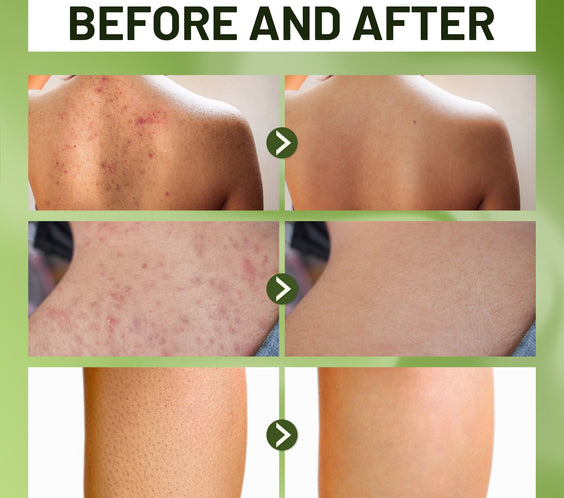 ABERA Folliculitis, BHA Shower Gel, High-Performance Folliculitis Body Wash, Wild Bitter Melon Extract