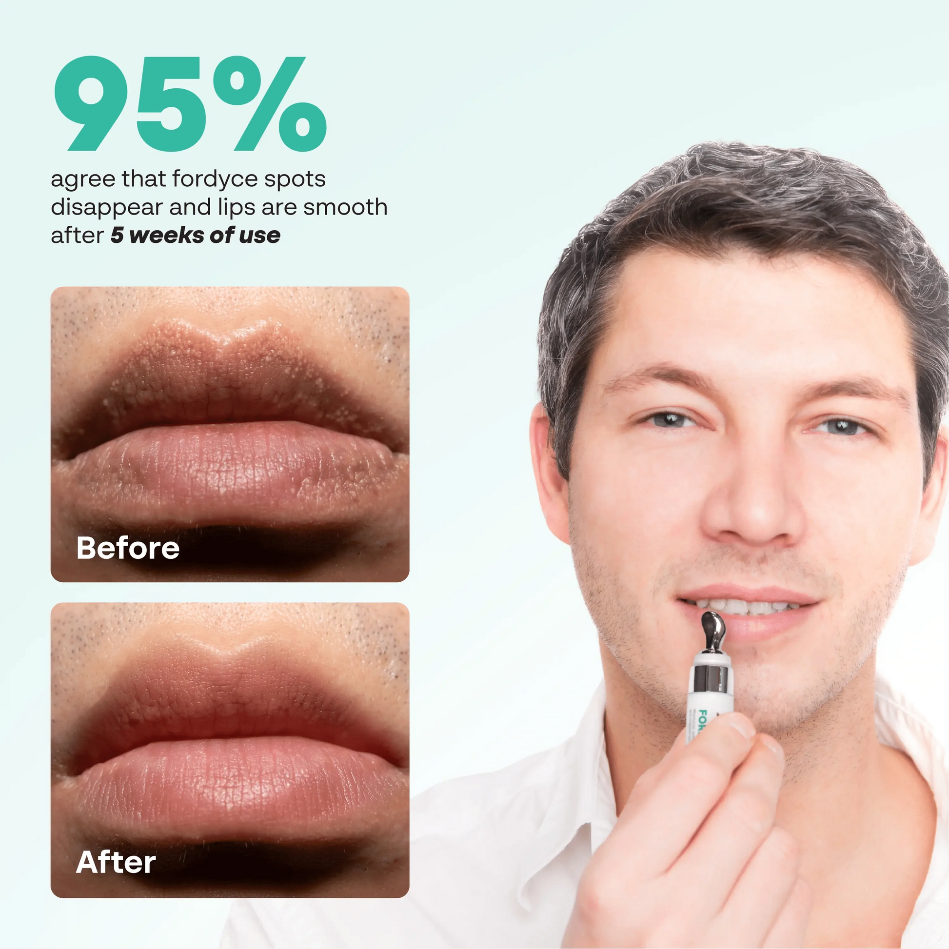 Abera Fordyce Cream – Advanced Formula with HPR (Next-Gen Retinoids), Fordyce Spot & Lip Acne Remover, All-day Moisturizing, Help Improve Dry, Chapped and Dark Lips, For Sensitive Lips (0.7 Oz)