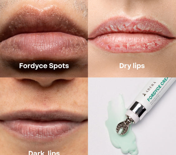 Abera Fordyce Cream – Advanced Formula with HPR (Next-Gen Retinoids), Fordyce Spot & Lip Acne Remover, All-day Moisturizing, Help Improve Dry, Chapped and Dark Lips, For Sensitive Lips (0.7 Oz)