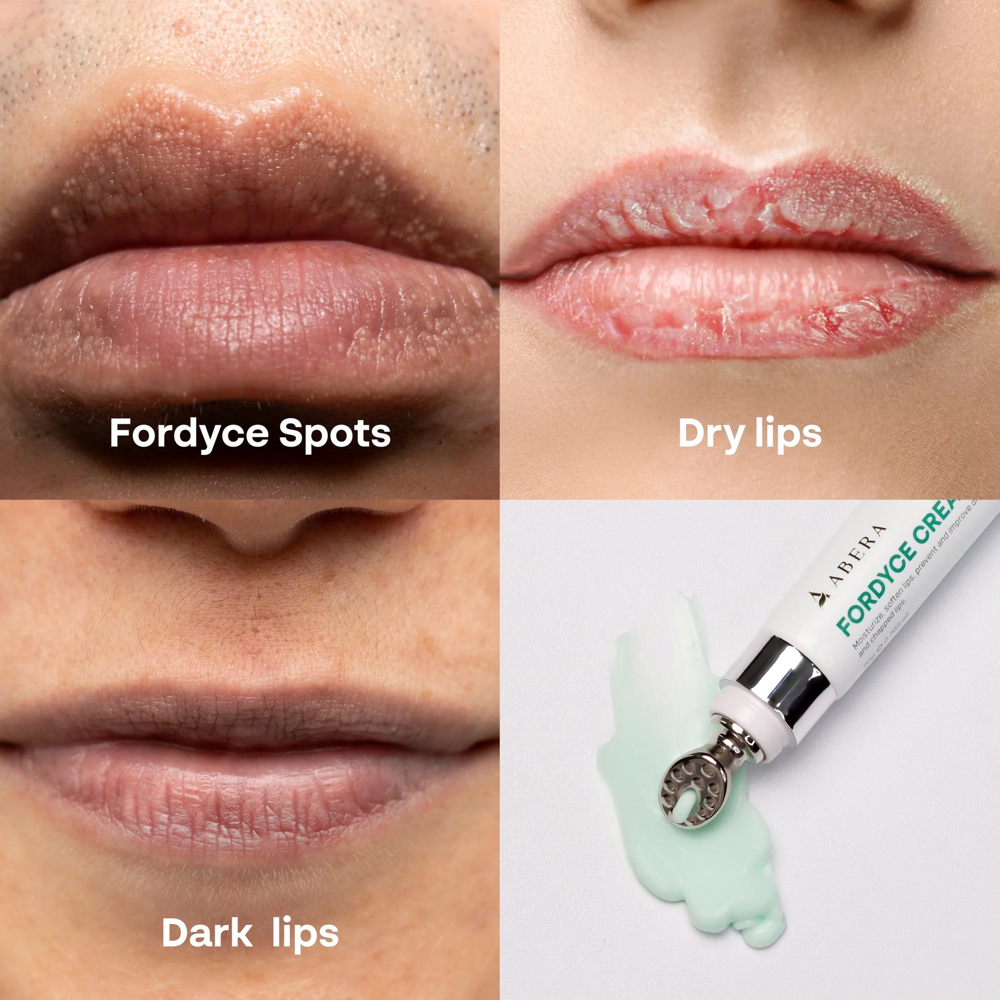 Abera Fordyce Cream – Advanced Formula with HPR (Next-Gen Retinoids), Fordyce Spot & Lip Acne Remover, All-day Moisturizing, Help Improve Dry, Chapped and Dark Lips, For Sensitive Lips (0.7 Oz)