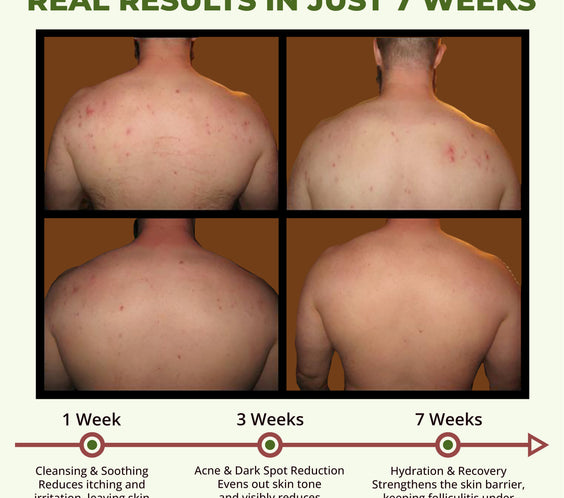 ABERA Folliculitis, BHA Shower Gel, High-Performance Folliculitis Body Wash, Wild Bitter Melon Extract