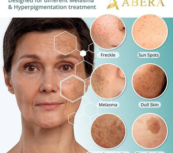 Abera Melasma Serum