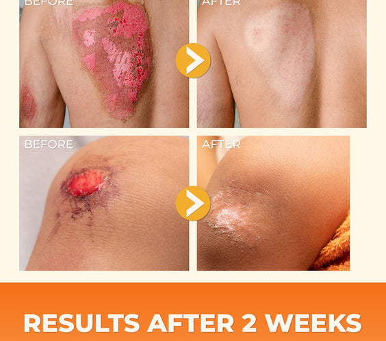 ABERA Red Turmeric Scar Removal Cream