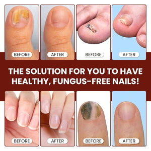 Abera Nail Fungus Serum - Hydrating & Conditioning Formula for Dry or Hardened Nails – Quick - Drying Daily Nail Support - ABERA SHOP